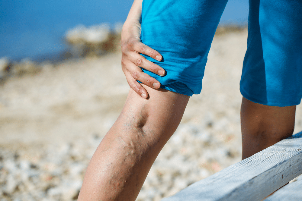 8 Signs Of When Is The Best Time To See A Vein Specialist