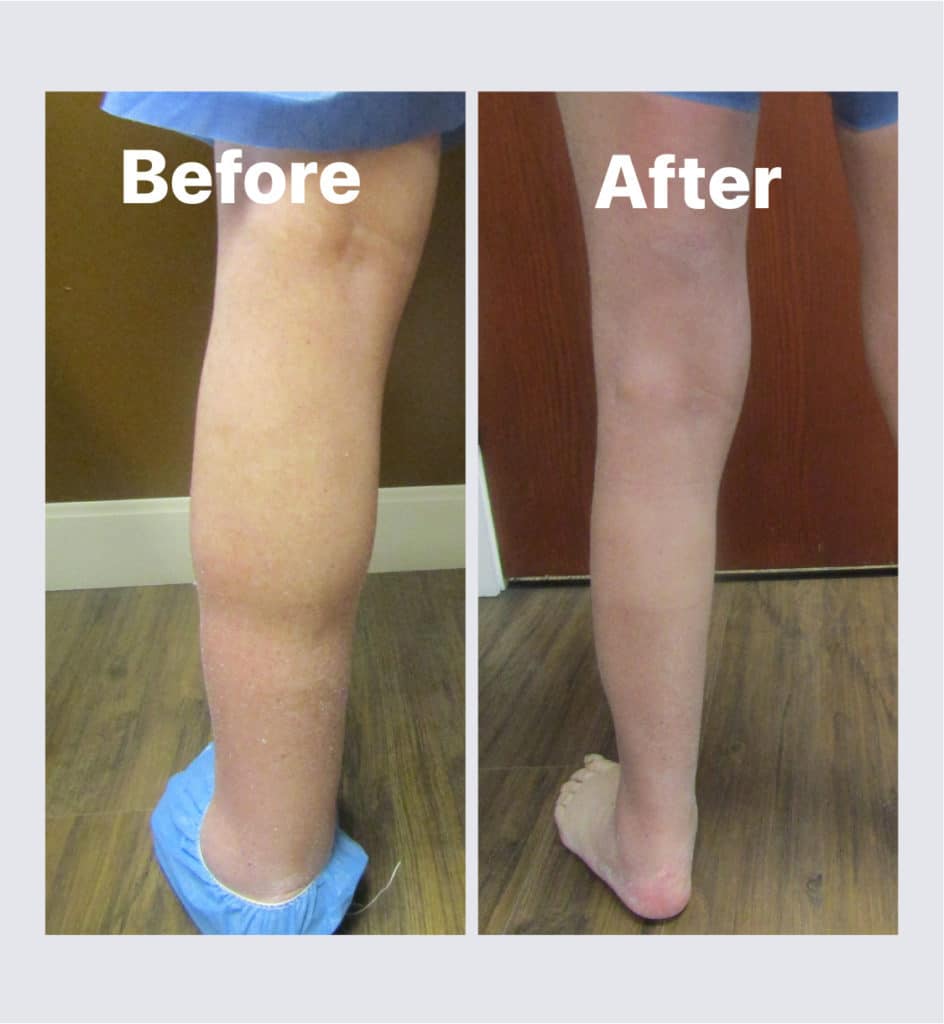 Lymphedema Treatment Before and After | Venus Vein Clinic