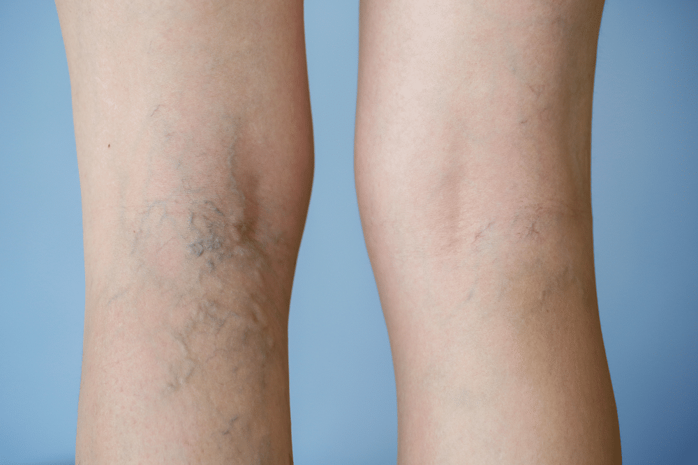 Varicose Veins Treatment Before and Afters