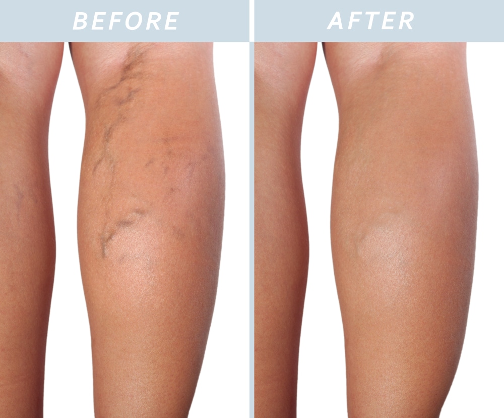 Beyond Aesthetics: The Medical Benefits of Vein Removal Treatments | Venus Vein Clinic