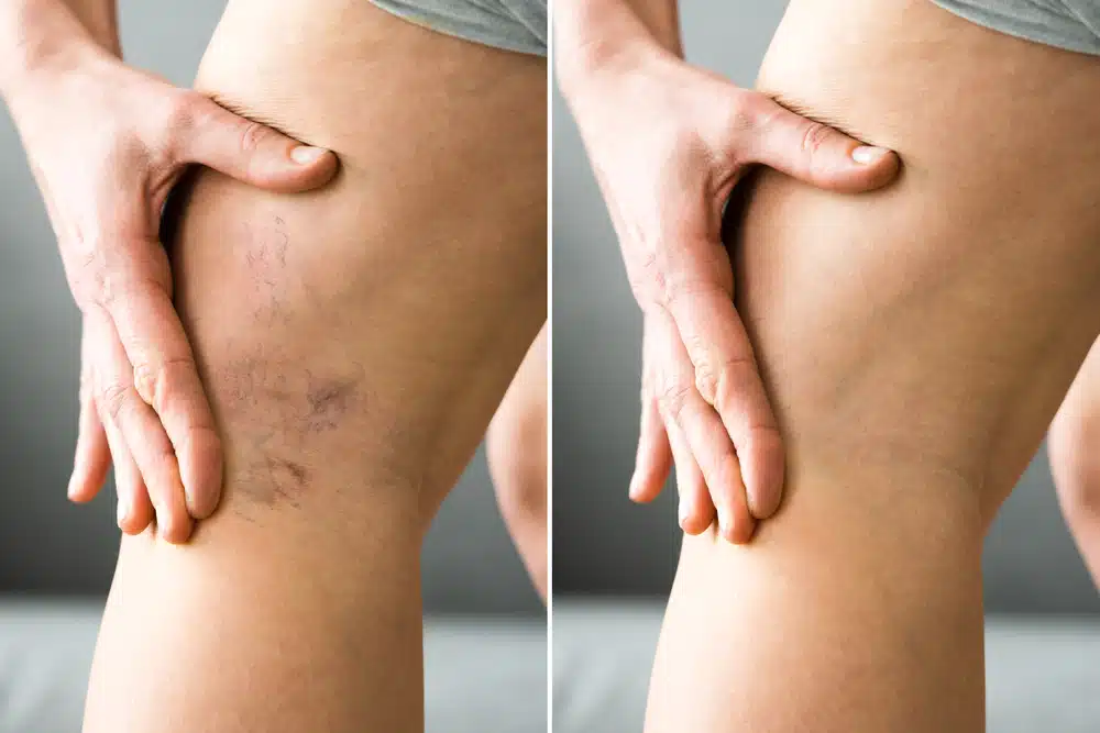 Exploring insurance coverage for vein treatment options.